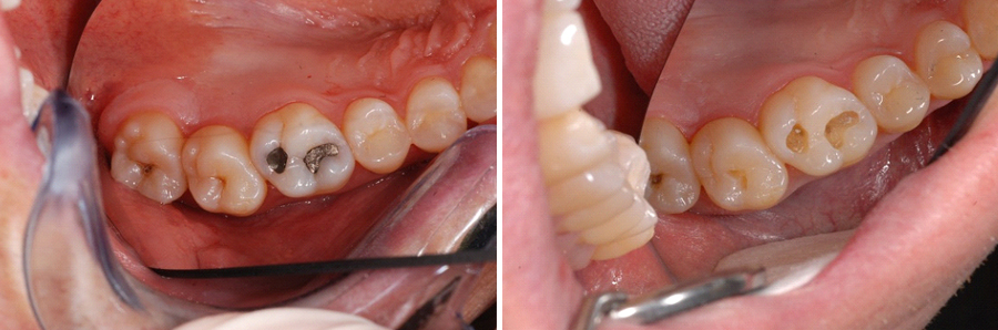 Leaking Amalgam Fillings Case Study | Care 4 Smiles