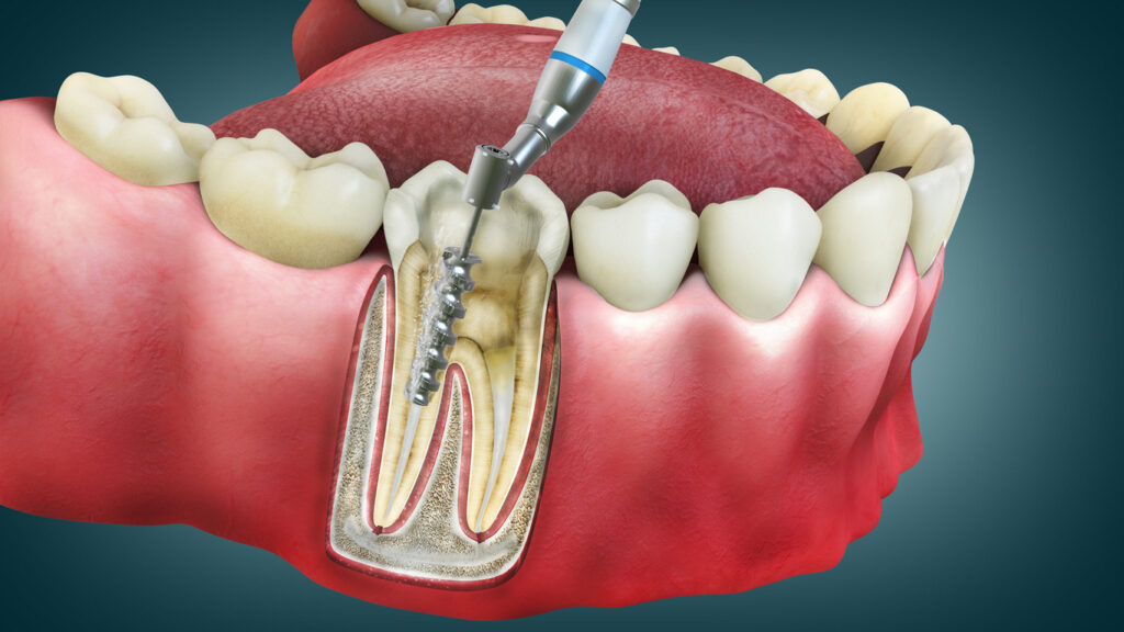 An illustration of a tooth undergoing a root canal treatment.